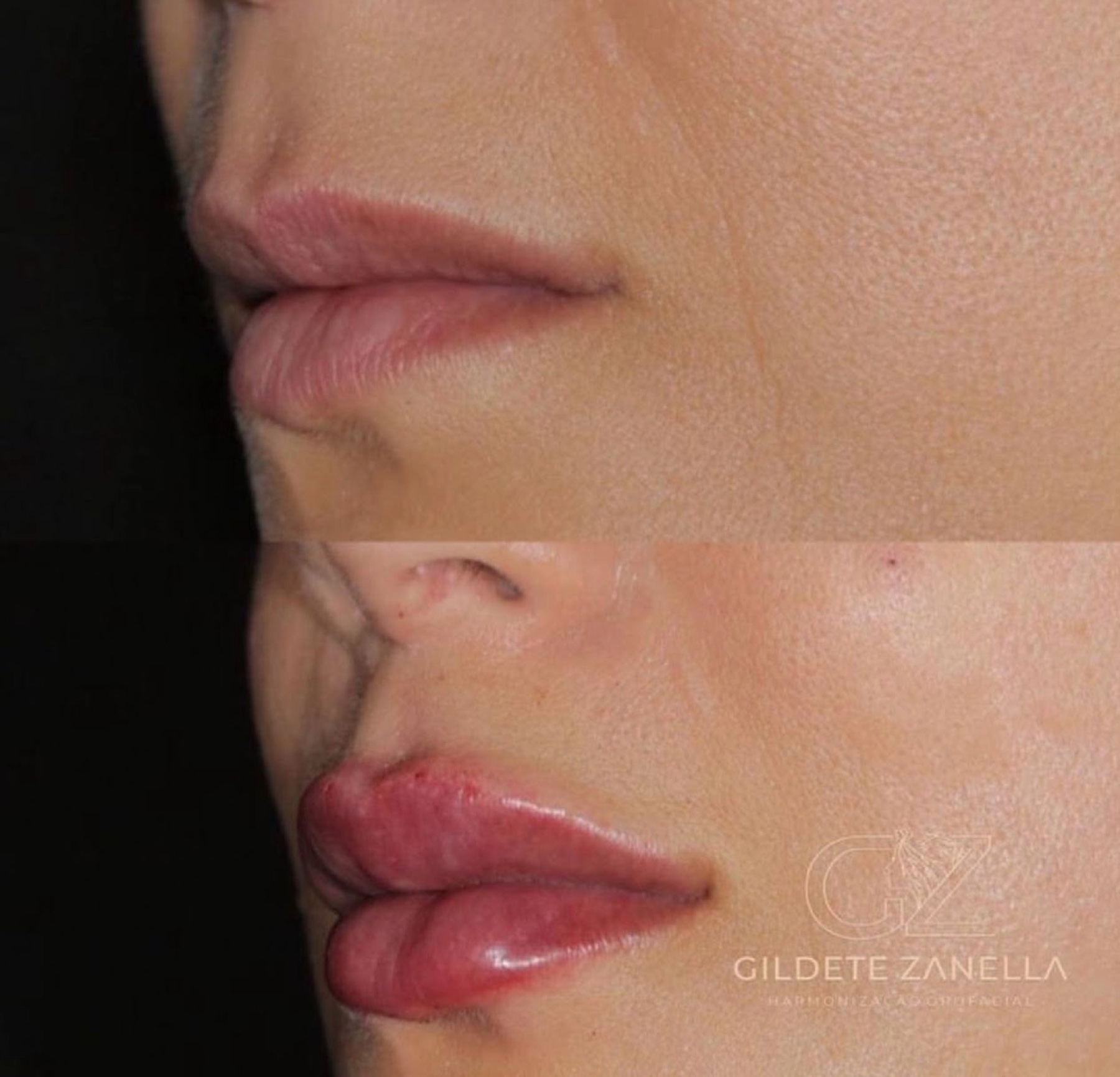 Antes e depois de caso New Lips conduzido por Gildete Zanella