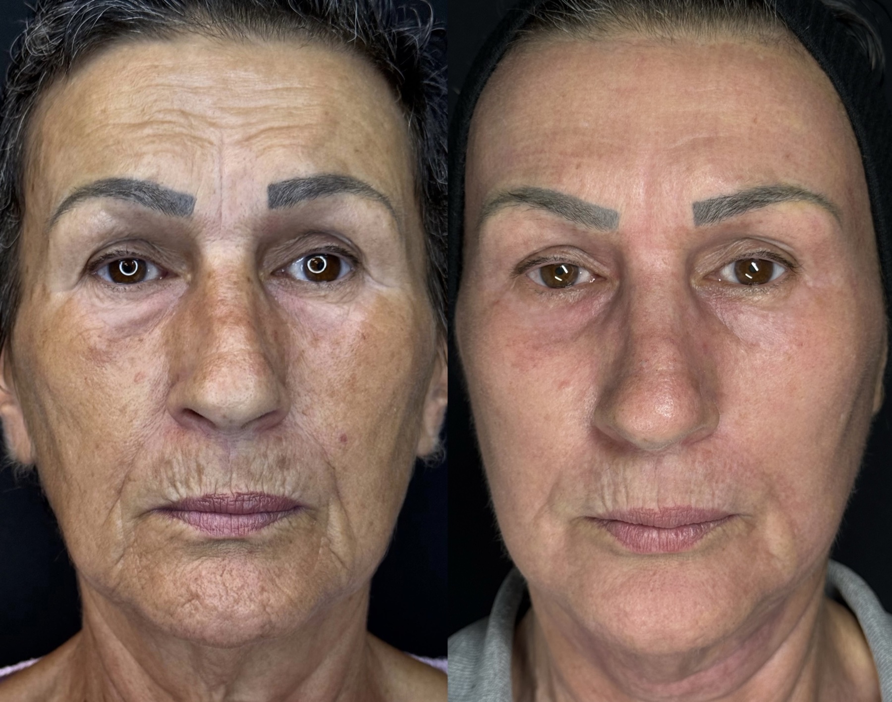 Antes e depois de caso Protocolo New Lifting conduzido por Gildete Zanella