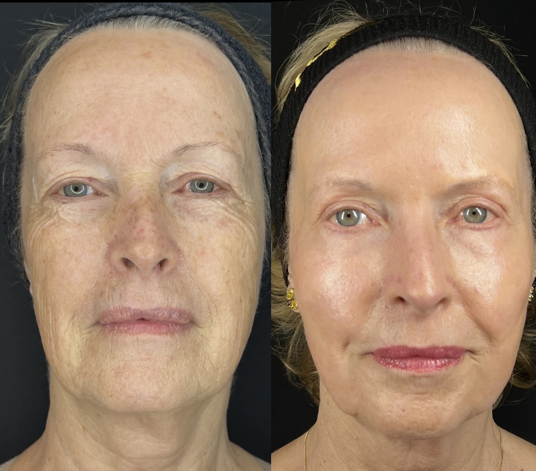 Antes e depois de caso Protocolo New Lifting conduzido por Gildete Zanella