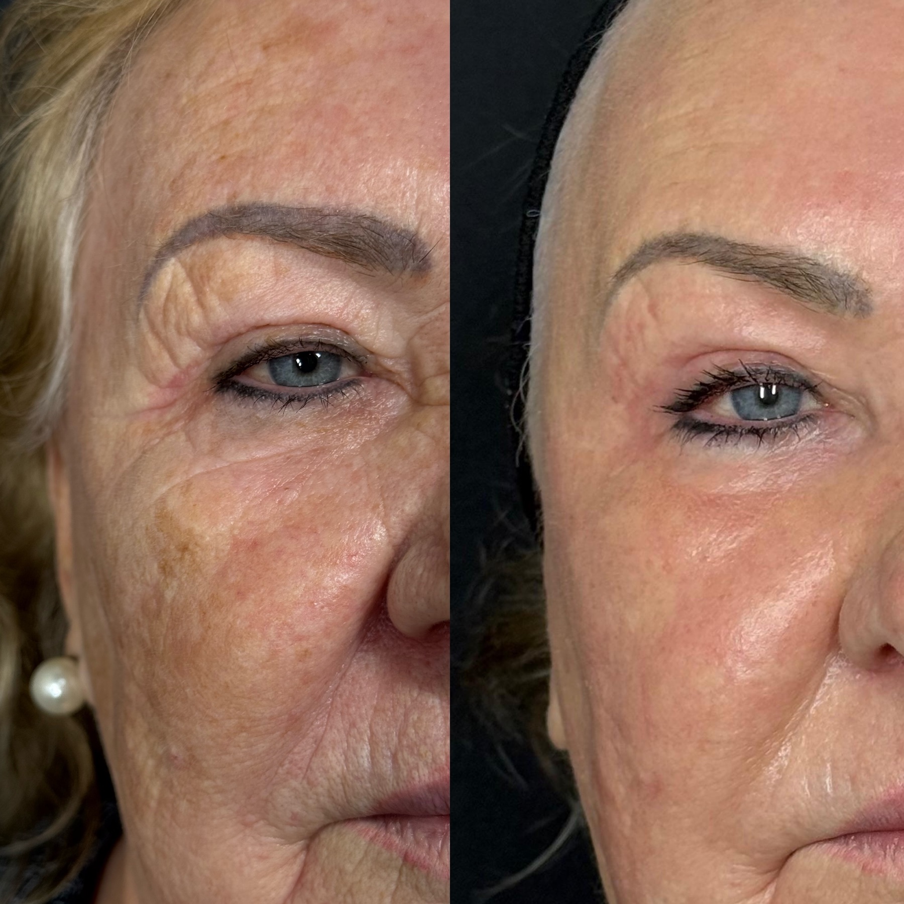 Antes e depois de caso Protocolo New Lifting conduzido por Gildete Zanella